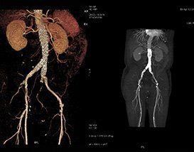 Angioscanner vasculaire