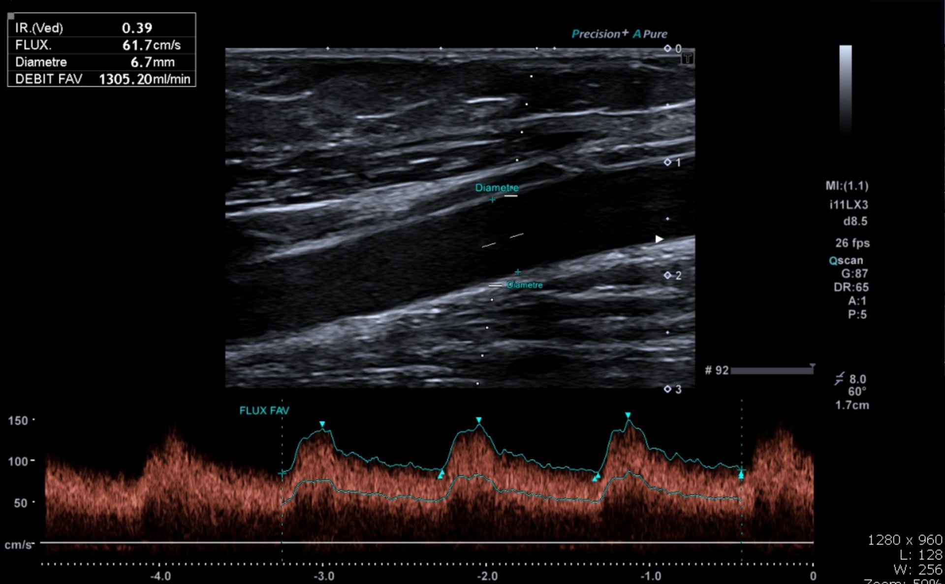 Doppler de fistule artério-veineuse chez un patient dialysé