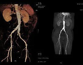 Angioscanner vasculaire