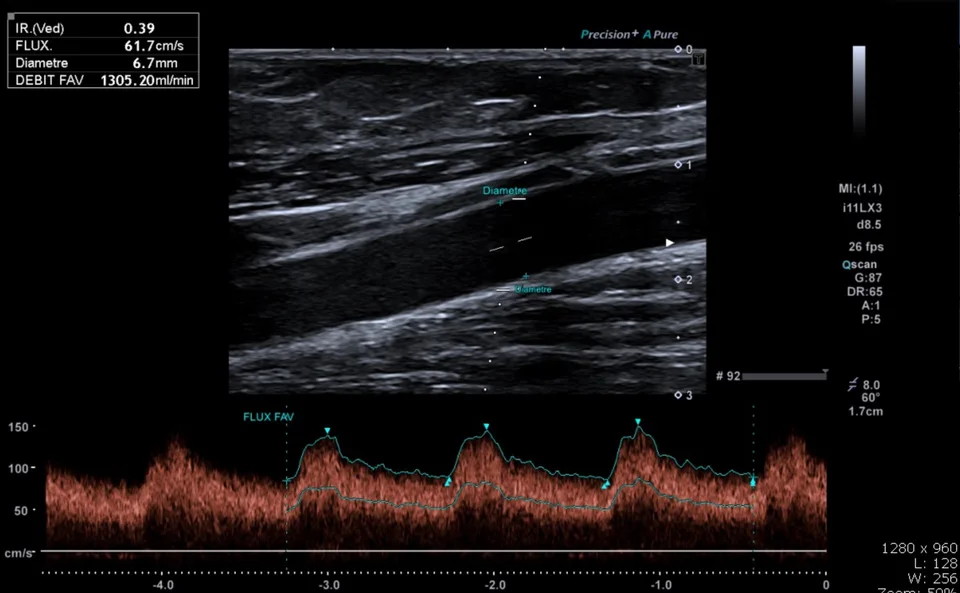 Doppler de fistule artério-veineuse chez un patient dialysé