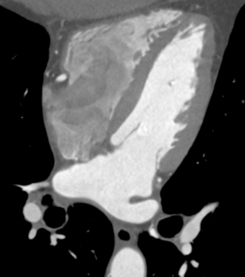 Scanner Cardiaque