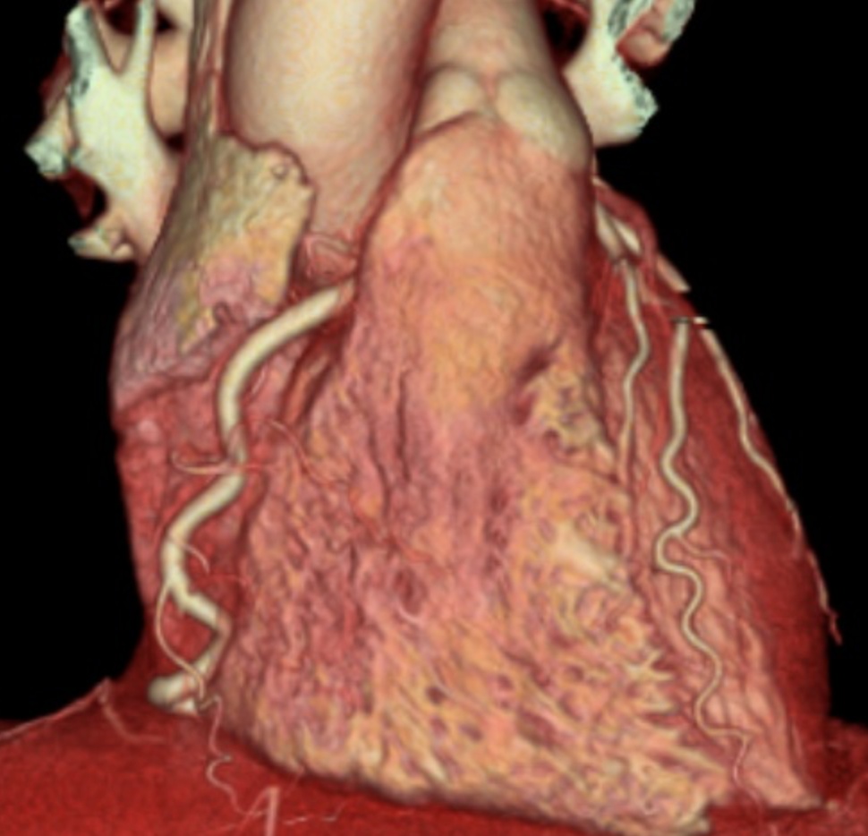 Scanner Cardiaque