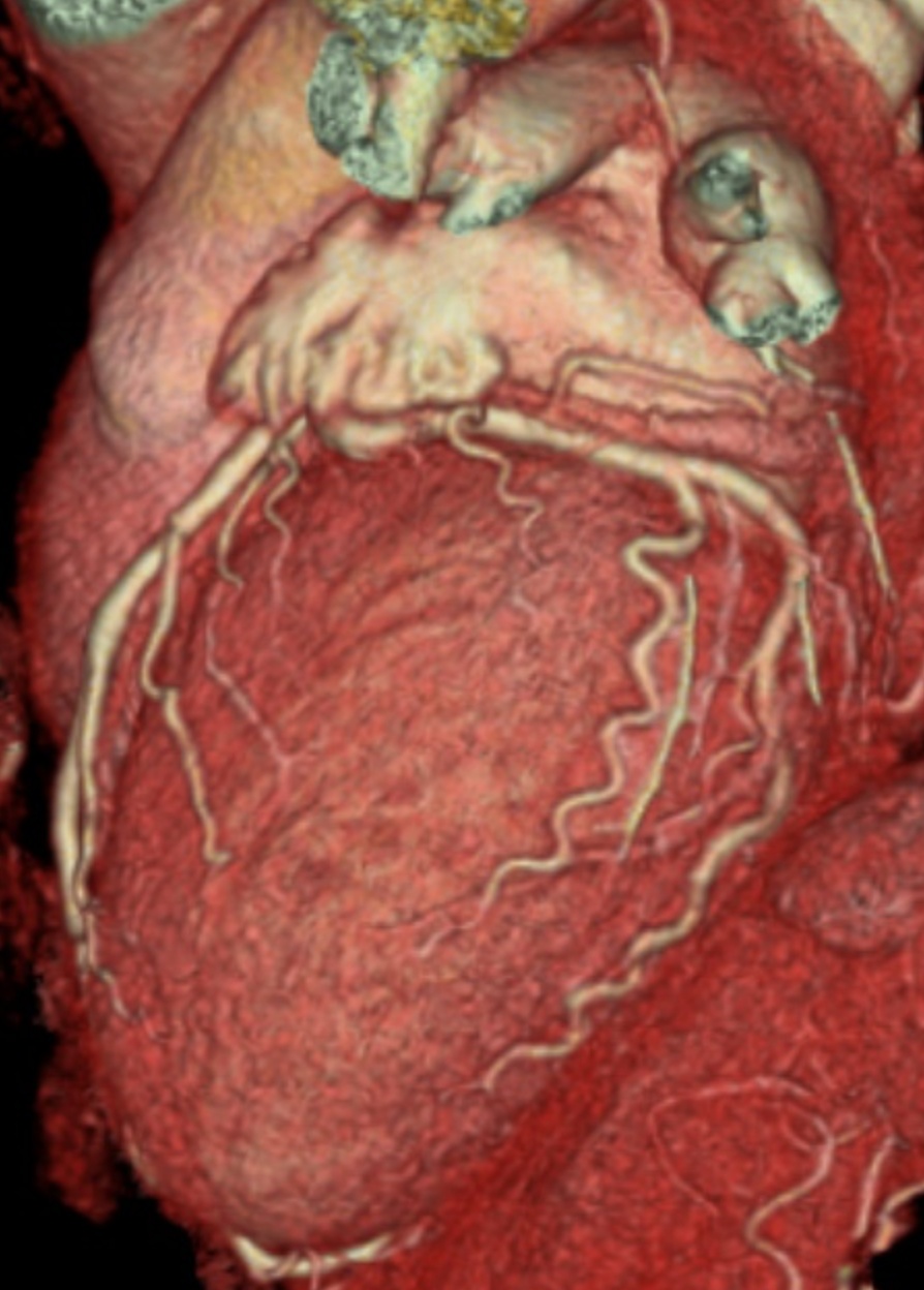 Scanner Cardiaque