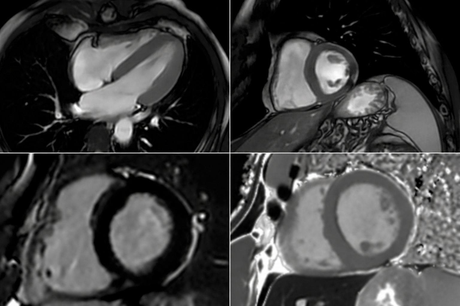 IRM cardiaque 